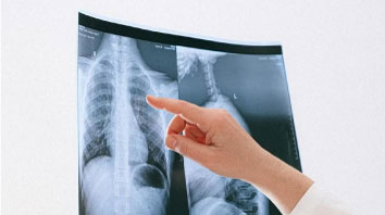 Lung cancer screening should be extended to non-smokers: Expert