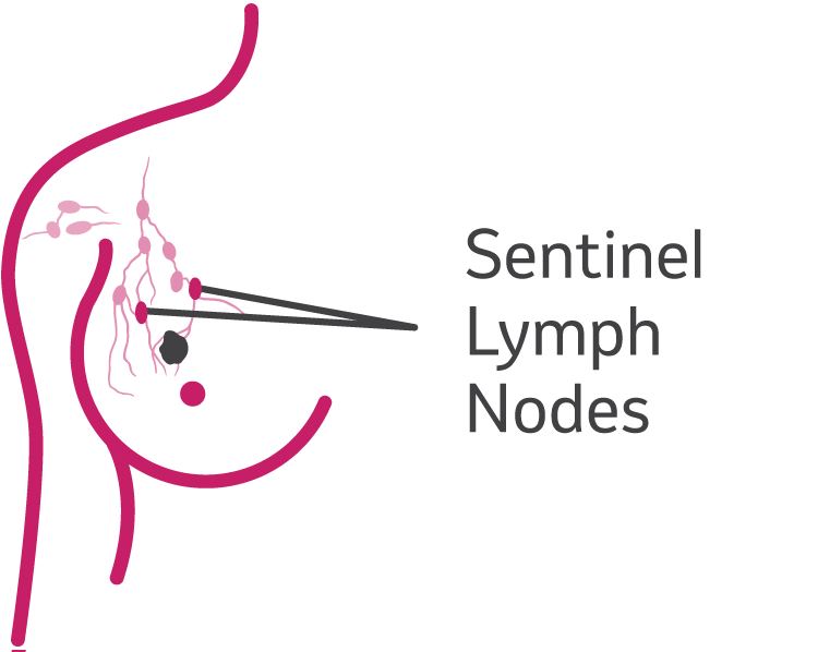 Sentinel Lymph Node Biopsy (SLNB) or Axillary Lymph Node Dissection (ALND)